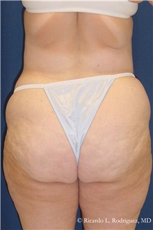 Body Lift Before Photo by Ricardo Rodriguez, MD; Lutherville-Timonium, MD - Case 32412