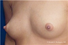 Breast Augmentation Before Photo by Ricardo Rodriguez, MD; Lutherville-Timonium, MD - Case 32416