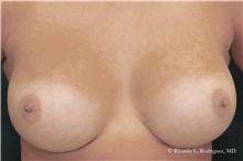 Breast Augmentation After Photo by Ricardo Rodriguez, MD; Lutherville-Timonium, MD - Case 32416