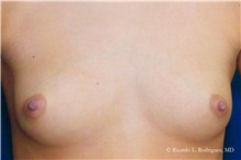 Breast Augmentation Before Photo by Ricardo Rodriguez, MD; Lutherville-Timonium, MD - Case 32416