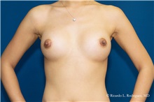 Breast Augmentation Before Photo by Ricardo Rodriguez, MD; Lutherville-Timonium, MD - Case 32417