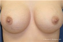 Breast Augmentation After Photo by Ricardo Rodriguez, MD; Lutherville-Timonium, MD - Case 32418