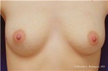 Breast Augmentation Before Photo by Ricardo Rodriguez, MD; Lutherville-Timonium, MD - Case 32418