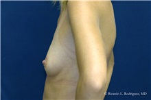 Breast Augmentation Before Photo by Ricardo Rodriguez, MD; Lutherville-Timonium, MD - Case 32422