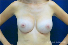 Breast Augmentation After Photo by Ricardo Rodriguez, MD; Lutherville-Timonium, MD - Case 32424