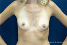 Breast Augmentation Before Photo by Ricardo Rodriguez, MD; Lutherville-Timonium, MD - Case 32424