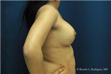 Breast Augmentation After Photo by Ricardo Rodriguez, MD; Lutherville-Timonium, MD - Case 32425