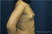 Breast Augmentation Before Photo by Ricardo Rodriguez, MD; Lutherville-Timonium, MD - Case 32425