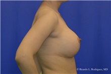 Breast Augmentation After Photo by Ricardo Rodriguez, MD; Lutherville-Timonium, MD - Case 32426