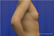 Breast Augmentation Before Photo by Ricardo Rodriguez, MD; Lutherville-Timonium, MD - Case 32426