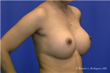 Breast Augmentation After Photo by Ricardo Rodriguez, MD; Lutherville-Timonium, MD - Case 32427