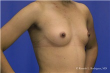 Breast Augmentation Before Photo by Ricardo Rodriguez, MD; Lutherville-Timonium, MD - Case 32427