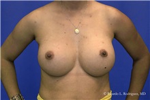 Breast Augmentation After Photo by Ricardo Rodriguez, MD; Lutherville-Timonium, MD - Case 32428