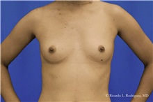 Breast Augmentation Before Photo by Ricardo Rodriguez, MD; Lutherville-Timonium, MD - Case 32428
