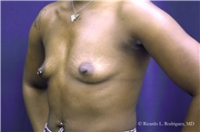 Breast Augmentation Before Photo by Ricardo Rodriguez, MD; Lutherville-Timonium, MD - Case 32433