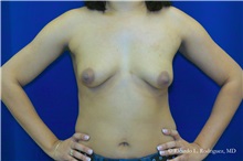 Breast Augmentation Before Photo by Ricardo Rodriguez, MD; Lutherville-Timonium, MD - Case 32435