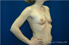 Breast Augmentation Before Photo by Ricardo Rodriguez, MD; Lutherville-Timonium, MD - Case 32436