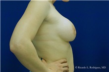Breast Augmentation After Photo by Ricardo Rodriguez, MD; Lutherville-Timonium, MD - Case 32436