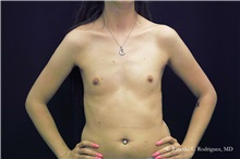 Breast Augmentation Before Photo by Ricardo Rodriguez, MD; Lutherville-Timonium, MD - Case 32438