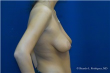 Breast Augmentation Before Photo by Ricardo Rodriguez, MD; Lutherville-Timonium, MD - Case 32439