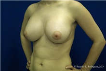 Breast Augmentation After Photo by Ricardo Rodriguez, MD; Lutherville-Timonium, MD - Case 32440