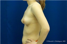 Breast Augmentation Before Photo by Ricardo Rodriguez, MD; Lutherville-Timonium, MD - Case 32440