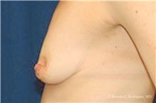 Breast Lift Before Photo by Ricardo Rodriguez, MD; Lutherville-Timonium, MD - Case 32441