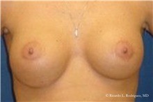Breast Augmentation After Photo by Ricardo Rodriguez, MD; Lutherville-Timonium, MD - Case 32442