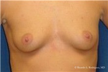 Breast Augmentation Before Photo by Ricardo Rodriguez, MD; Lutherville-Timonium, MD - Case 32442