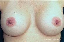 Breast Augmentation After Photo by Ricardo Rodriguez, MD; Lutherville-Timonium, MD - Case 32445