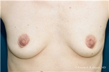 Breast Augmentation Before Photo by Ricardo Rodriguez, MD; Lutherville-Timonium, MD - Case 32445