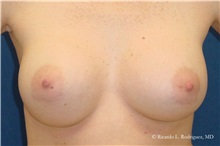 Breast Augmentation After Photo by Ricardo Rodriguez, MD; Lutherville-Timonium, MD - Case 32447