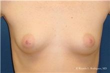Breast Augmentation Before Photo by Ricardo Rodriguez, MD; Lutherville-Timonium, MD - Case 32447