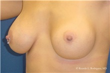 Breast Augmentation After Photo by Ricardo Rodriguez, MD; Lutherville-Timonium, MD - Case 32448