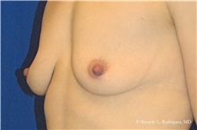 Breast Augmentation Before Photo by Ricardo Rodriguez, MD; Lutherville-Timonium, MD - Case 32448
