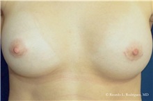 Breast Augmentation After Photo by Ricardo Rodriguez, MD; Lutherville-Timonium, MD - Case 32449