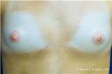 Breast Augmentation Before Photo by Ricardo Rodriguez, MD; Lutherville-Timonium, MD - Case 32449