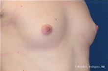 Breast Augmentation Before Photo by Ricardo Rodriguez, MD; Lutherville-Timonium, MD - Case 32451