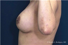 Breast Augmentation After Photo by Ricardo Rodriguez, MD; Lutherville-Timonium, MD - Case 32454