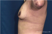 Breast Augmentation Before Photo by Ricardo Rodriguez, MD; Lutherville-Timonium, MD - Case 32454