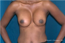 Breast Augmentation After Photo by Ricardo Rodriguez, MD; Lutherville-Timonium, MD - Case 32456