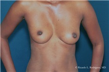 Breast Augmentation Before Photo by Ricardo Rodriguez, MD; Lutherville-Timonium, MD - Case 32456