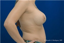 Breast Augmentation After Photo by Ricardo Rodriguez, MD; Lutherville-Timonium, MD - Case 32458