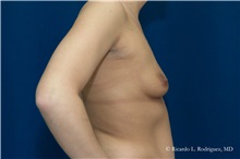 Breast Augmentation Before Photo by Ricardo Rodriguez, MD; Lutherville-Timonium, MD - Case 32458