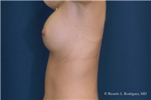 Breast Augmentation After Photo by Ricardo Rodriguez, MD; Lutherville-Timonium, MD - Case 32459