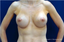 Breast Augmentation After Photo by Ricardo Rodriguez, MD; Lutherville-Timonium, MD - Case 32463