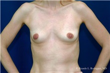 Breast Augmentation Before Photo by Ricardo Rodriguez, MD; Lutherville-Timonium, MD - Case 32463