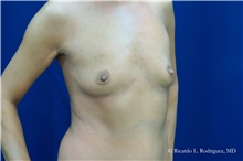 Breast Augmentation Before Photo by Ricardo Rodriguez, MD; Lutherville-Timonium, MD - Case 32464