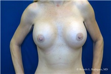 Breast Augmentation After Photo by Ricardo Rodriguez, MD; Lutherville-Timonium, MD - Case 32464