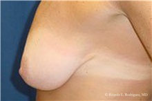 Breast Lift Before Photo by Ricardo Rodriguez, MD; Lutherville-Timonium, MD - Case 32466